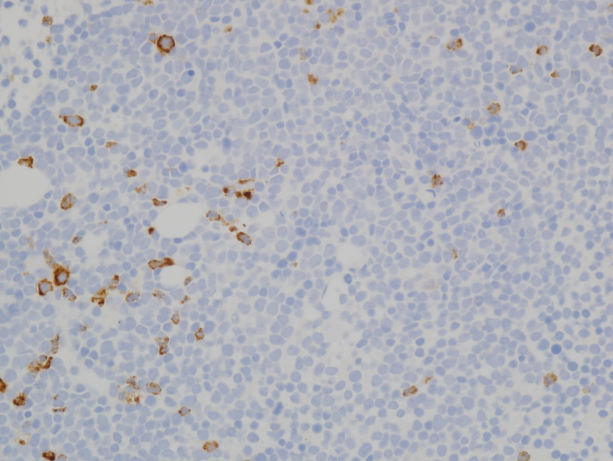 Figure 5(MPO): Immunohistochemistry of bone marrow clot sections (400x magnification).